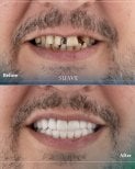 Before and after dental crown installation results at SUAVE DENTAL CLINIC, smile restoration