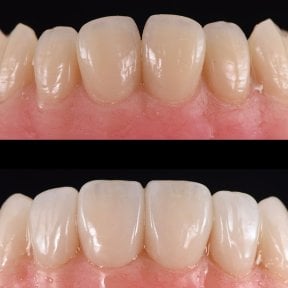 Before and after no prep veneers at Yonsei JW Dental Clinic, improved smile aesthetics result