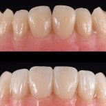 Before and after no prep veneers at Yonsei JW Dental Clinic, improved smile aesthetics result