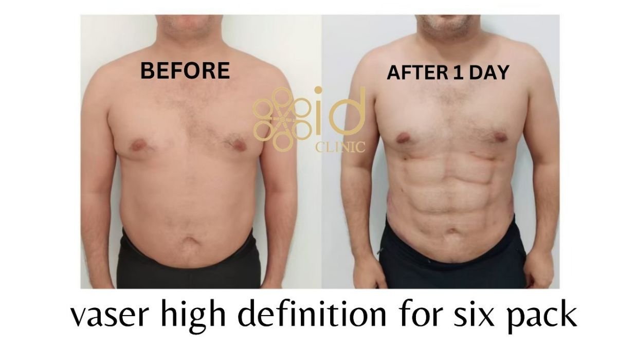 Résultats avant/après VASER abdominal pour six pack à ID Clinic Bangkok