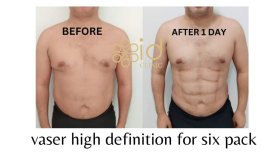 نتائج قبل وبعد نحت البطن VASER لعضلات البطن في ID Clinic Bangkok