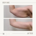 Before and after arm lift (brachioplasty) results at ID Clinic Bangkok, improved arm contour