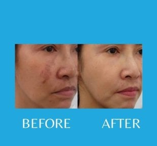 Результаты до и после PRP-терапии для омоложения кожи лица в ID Clinic Bangkok