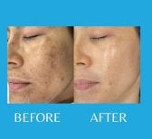 До и после PRP-терапии в ID Clinic Bangkok – улучшение текстуры и чистоты кожи лица