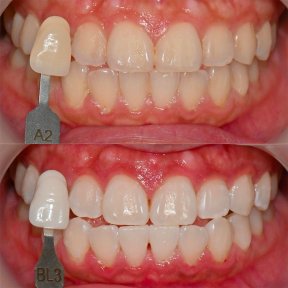 Before and after tooth whitening results at Yonsei JW Dental Clinic, visibly brighter smile