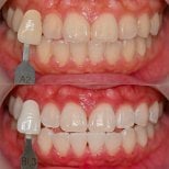 Before and after tooth whitening results at Yonsei JW Dental Clinic, visibly brighter smile