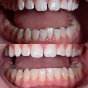 Результаты до и после Invisalign в YeahSmile – ровные зубы и улучшенная улыбка