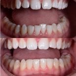Результаты до и после Invisalign в YeahSmile – ровные зубы и улучшенная улыбка
