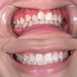Результаты до и после Invisalign в YeahSmile – ровные зубы и улучшенная улыбка