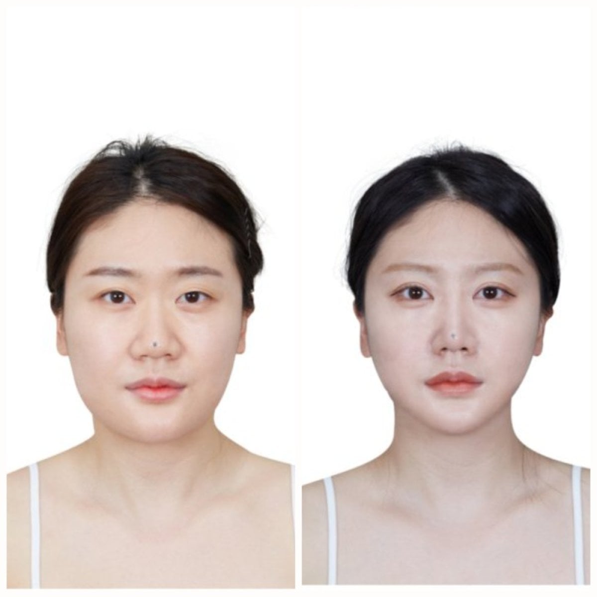 Resultados de contorno facial antes y después en Wonjin Plastic Surgery Clinic, rostro mejorado