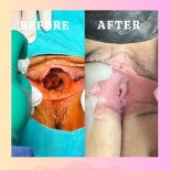 Vorher-nachher-Ergebnis der Klitoroplastik in der Dr. İrem Yengel Klinik, sichtbare Verfeinerung