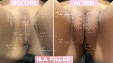 Vorher-nachher-Ergebnis der Labienvergrößerung mit Hyaluronsäure bei Dr. Özgür Ağlamış