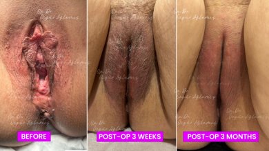 Labiaplastik Vorher-Nachher-Ergebnisse bei Dr. Özgür Ağlamış Barbieplasty Inventor