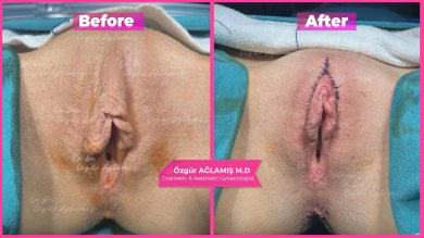 Vorher-nachher-Ergebnis der Labiaplastik bei Dr. Özgür Ağlamış Barbieplasty Inventor