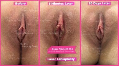 Vorher-nachher-Ergebnisse der Laser-Labioplastik bei Dr. Özgür Ağlamış Barbieplasty Inventor