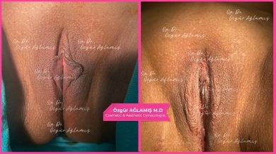 Vorher-nachher-Ergebnis der Labioplastik bei Dr. Özgür Ağlamış Barbieplasty Inventor