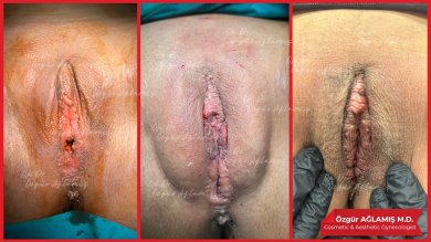 Vorher-nachher-Ergebnisse der Labiaplastik bei Dr. Özgür Ağlamış Barbieplasty Inventor
