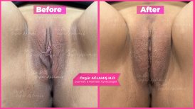 Vorher-nachher-Ergebnisse der Labiaplastik bei Dr. Özgür Ağlamış Barbieplasty Inventor