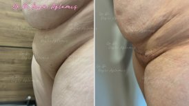 Vorher-nachher-Ergebnisse der Monsplastik bei Dr. Özgür Ağlamış Barbieplasty Inventor