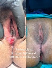 Vorher-nachher-Ergebnisse der Perineoplastik bei Dr. Özgür Ağlamış Barbieplasty Inventor