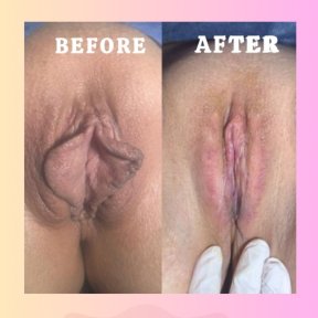 Vorher-nachher-Ergebnisse der Vaginoplastik in der Dr. İrem Yengel Klinik, verbessertes Aussehen