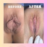 Vorher-nachher-Ergebnisse der Vaginoplastik in der Dr. İrem Yengel Klinik, verbessertes Aussehen