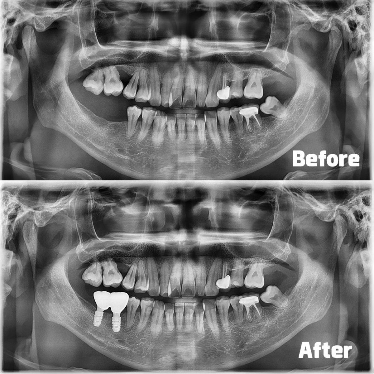 Resultados de implantes dentales antes y después en Yonsei JW Dental Clinic, restauración dental