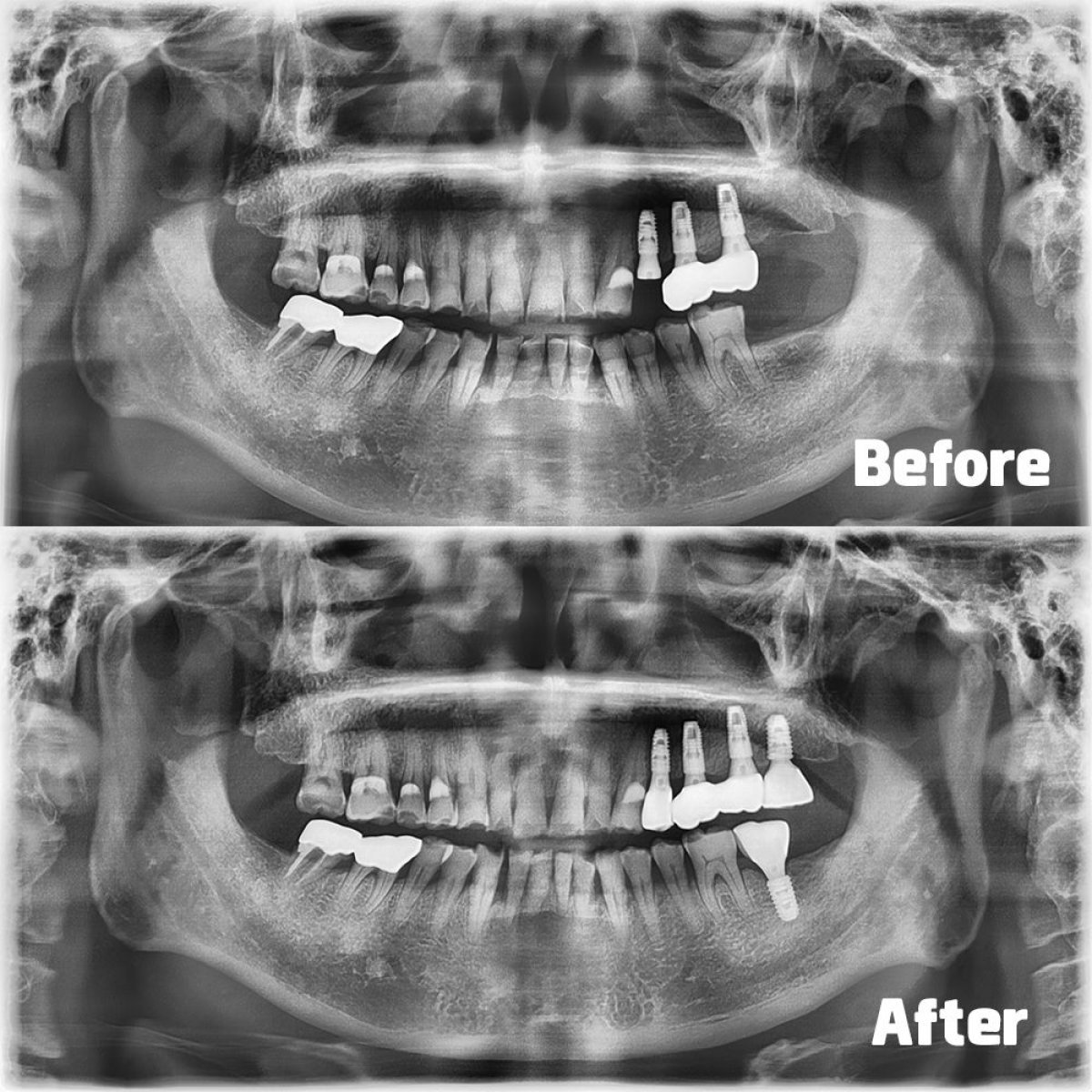 Resultados de implantes dentales antes y después en Yonsei JW Dental Clinic, restauración mandibular