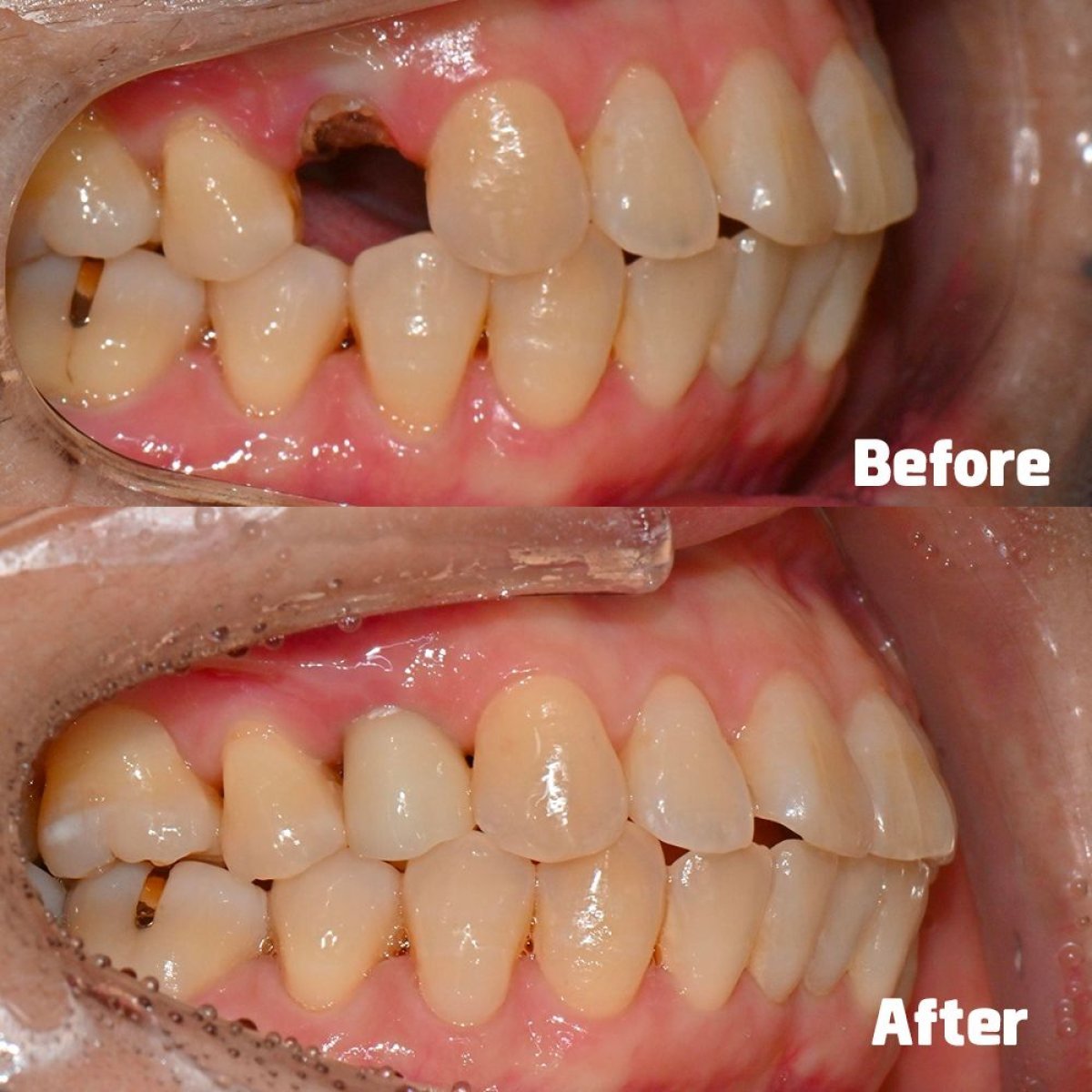 Resultados antes y después de implante dental en Yonsei JW Dental Clinic, diente restaurado