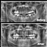 Résultats avant et après implants dentaires à Yonsei JW Dental Clinic, restauration de la mâchoire