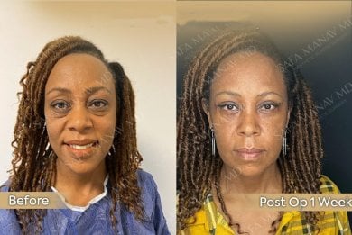 Blepharoplastik Vorher-Nachher-Ergebnis bei Dr. Safa Manav Clinic, Lidkorrektur