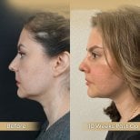 Vorher-nachher-Ergebnis Oberlidstraffung bei Dr. Safa Manav Clinic, verbesserte Augenkontur