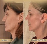 Vorher-nachher-Ergebnis Oberlidstraffung bei Dr. Safa Manav Clinic, 6 Wochen postoperativ