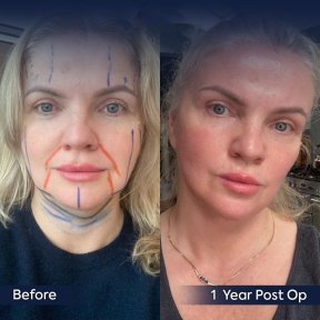 Vorher-nachher-Ergebnis Oberlidstraffung bei Dr. Safa Manav Clinic, 1 Jahr postoperativ