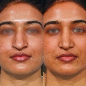 Facial feminization surgery before and after results at Memorial Bahçelievler Hospital