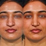 Facial feminization surgery before and after results at Memorial Bahçelievler Hospital