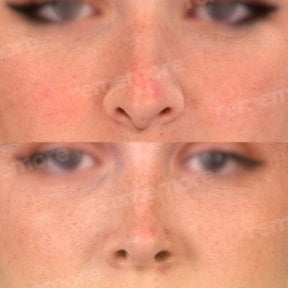 Facial feminization surgery before and after results at Memorial Bahçelievler Hospital, nose reshaping