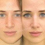 Facial feminization surgery before and after results at Memorial Bahçelievler Hospital