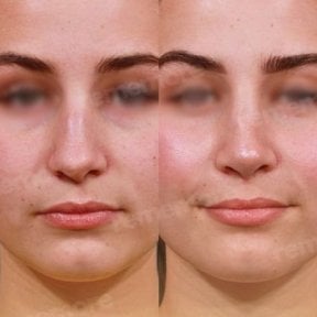 Facial feminization surgery before and after results at Memorial Bahçelievler Hospital