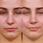 Facial feminization surgery before and after results at Memorial Bahçelievler Hospital