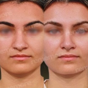 Facial feminization surgery before and after results at Memorial Bahçelievler Hospital