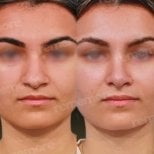 Facial feminization surgery before and after results at Memorial Bahçelievler Hospital
