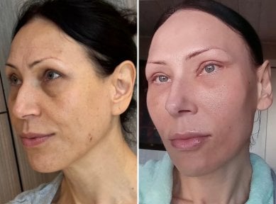 Vorher-nachher-Ergebnis Mini-Facelift bei Dr. Safa Manav Clinic, sichtbare Verjüngung