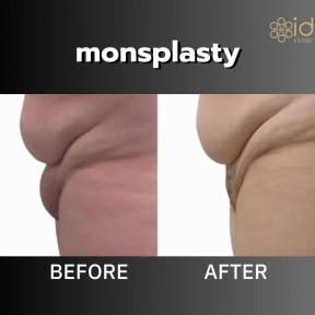 نتائج قبل وبعد عملية تصغير منطقة العانة في ID Clinic Bangkok – تقليل بروز العانة