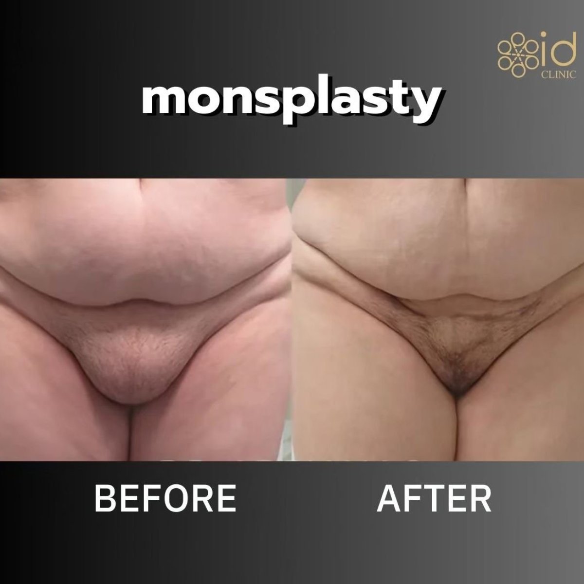 Результаты до и после монспластики в ID Clinic Bangkok – улучшенный контур лобка