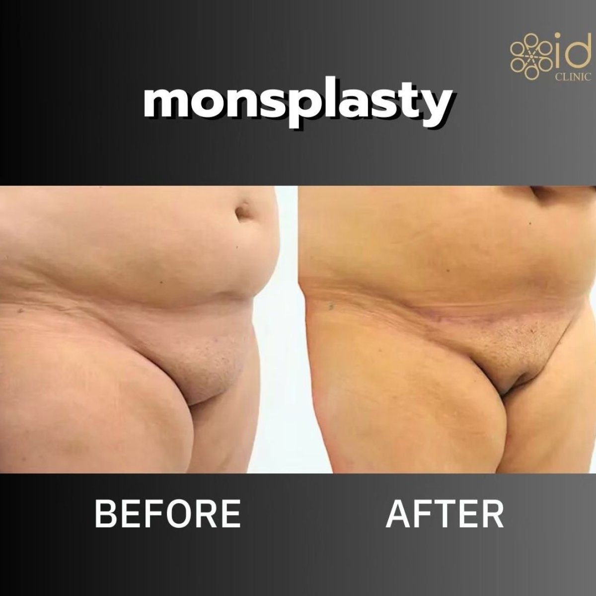 Результаты до и после монспластики в ID Clinic Bangkok – улучшенный контур лобка