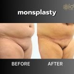 نتائج قبل وبعد عملية تصغير منطقة العانة في ID Clinic Bangkok – تحسين شكل العانة