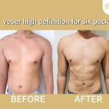 قبل وبعد نحت البطن في ID Clinic Bangkok، نتائج عضلات البطن الستة واضحة