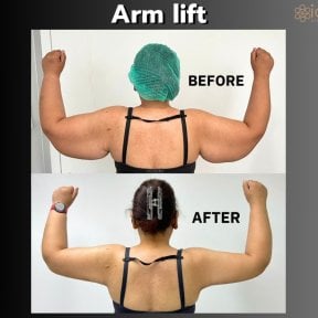 Before and after arm lift (brachioplasty) results at ID Clinic Bangkok, improved arm contour