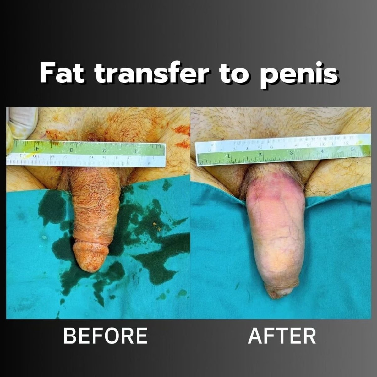 Resultados antes y después de transferencia de grasa al pene en ID Clinic Bangkok, mayor grosor